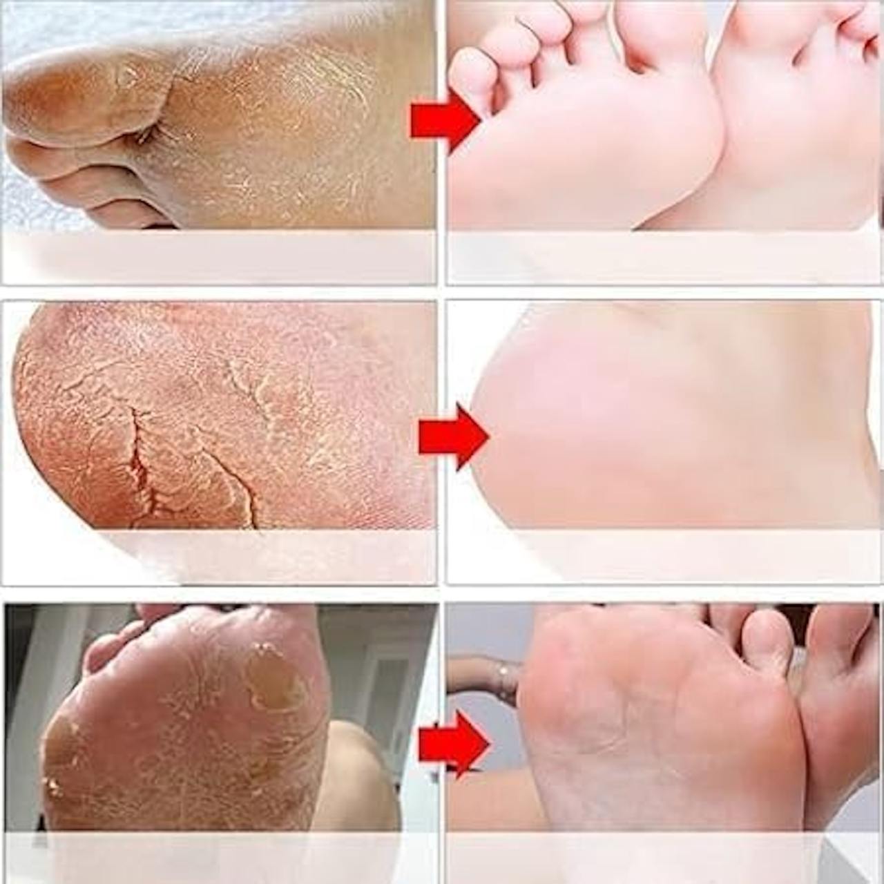 SaDoer foot peeling mask For Dead Skin Remover Heel | Removes Dry, Dead Skin & Hard Calluses |Nourishing & Hydrates Dry Feet with Shea Butter (Pack of 1)