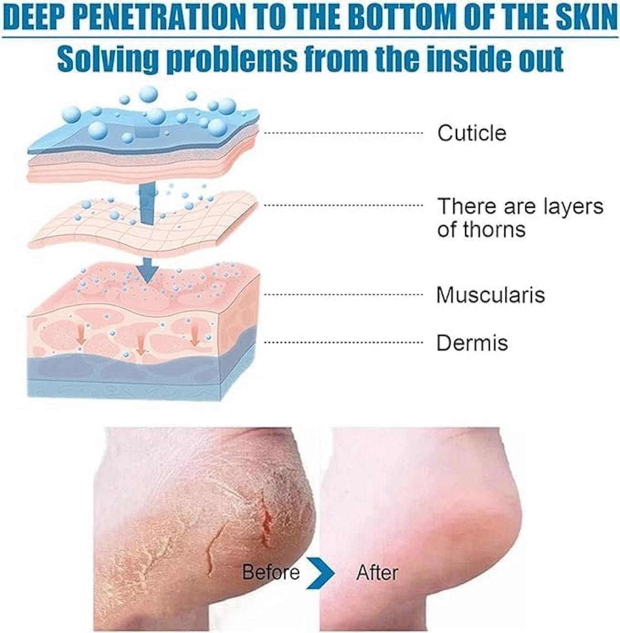 SaDoer foot peeling mask For Dead Skin Remover Heel | Removes Dry, Dead Skin & Hard Calluses |Nourishing & Hydrates Dry Feet with Shea Butter (Pack of 1)